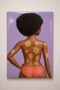 VITILIGO